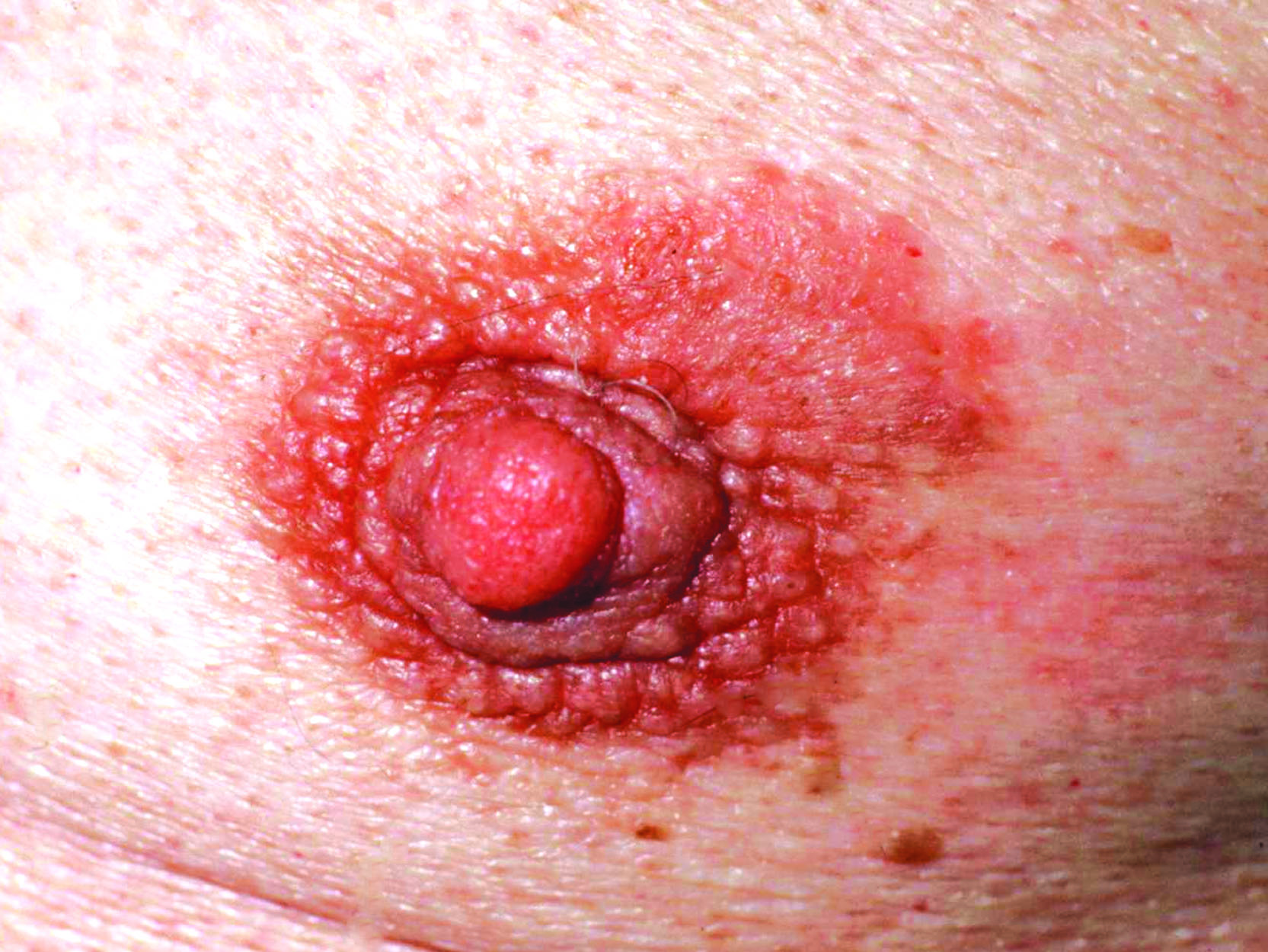 Eczema pathology | DermNet New Zealand