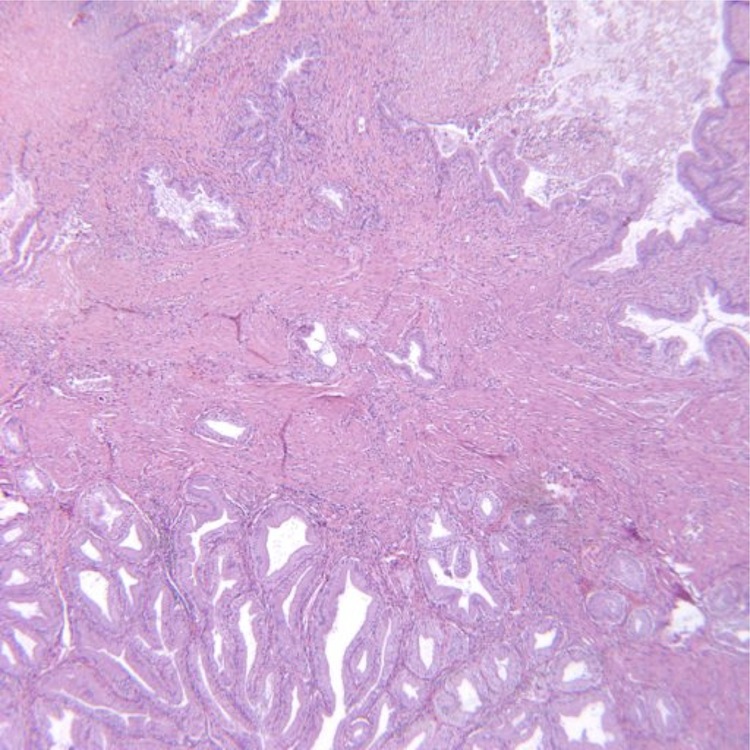 Pathology Outlines - Adenomyosis of gallbladder