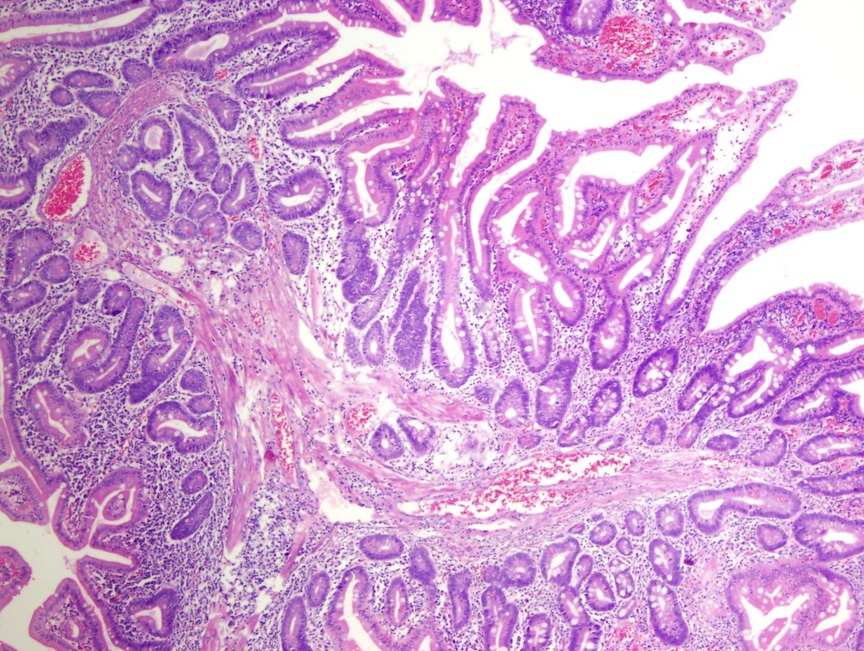 Pathology Outlines - Peutz-Jeghers polyp