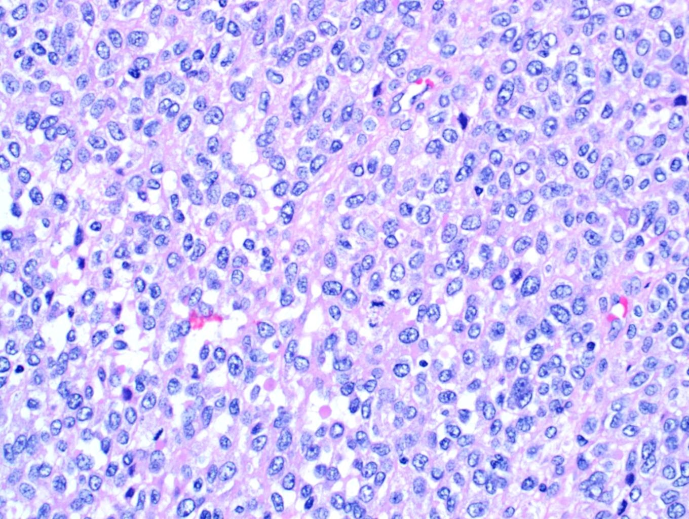 Pathology Outlines - Glomus tumor