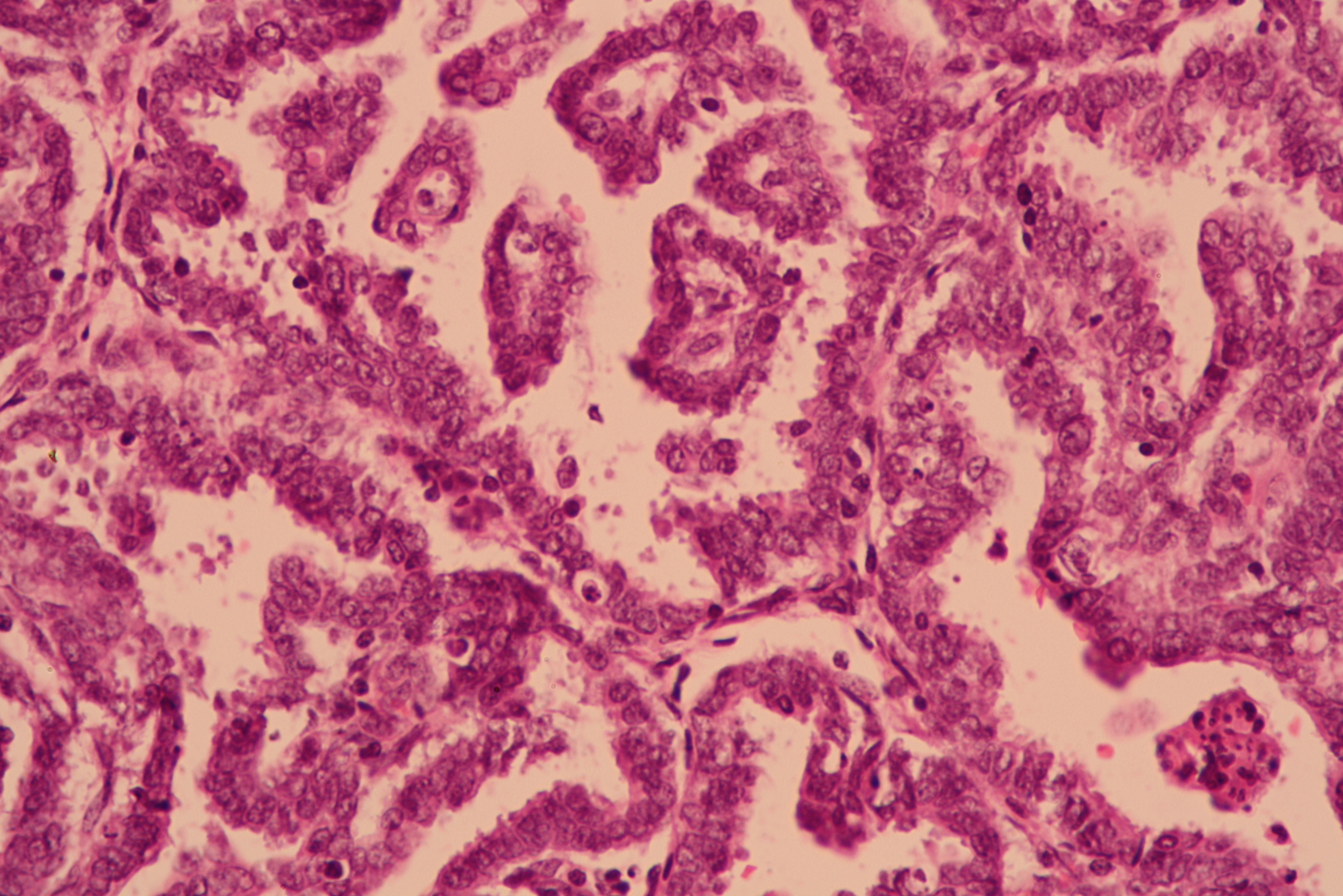 Pathology Outlines Case Of The Week 422