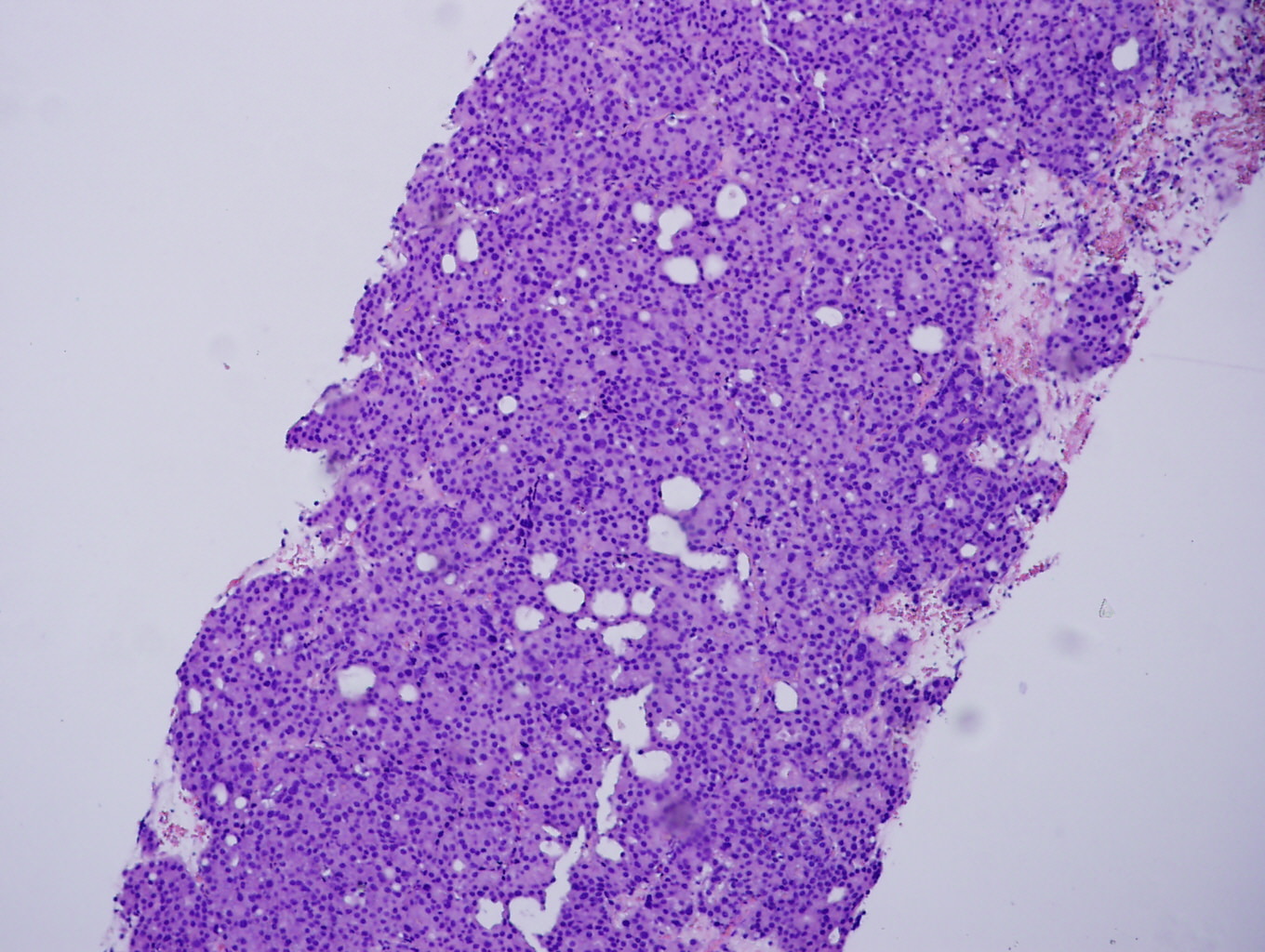 prostatic adenocarcinoma pathology outlines