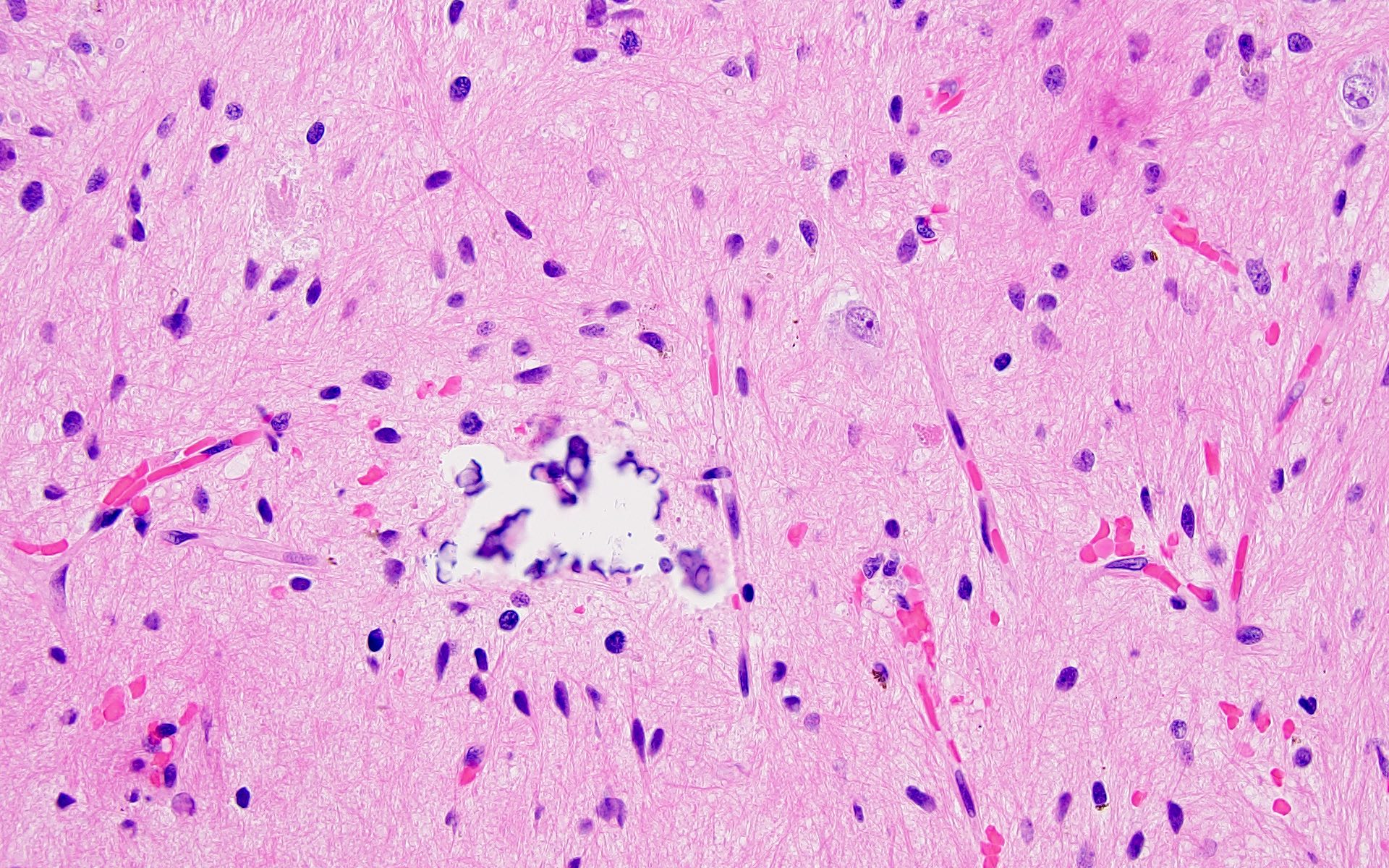 pathology-outlines-pituitary-adenoma-hot-sex-picture