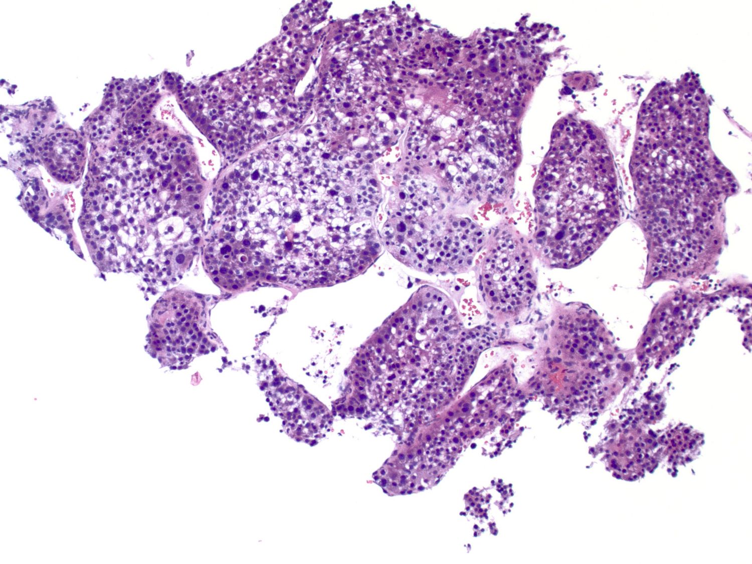 Liver And Intrahepatic Bile Ducts Tumor – Blog | PathologyOutlines.com