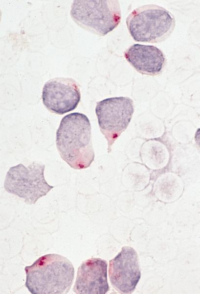 Pathology Outlines - T lymphoblastic lymphoma / leukemia