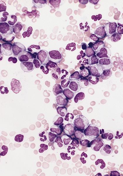 Chronic Myeloid Neoplasms - Chronic myelogenous leukemia (CML)