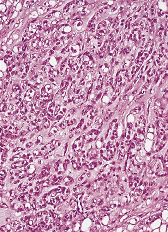 Pathology Outlines - Chondroid lipoma