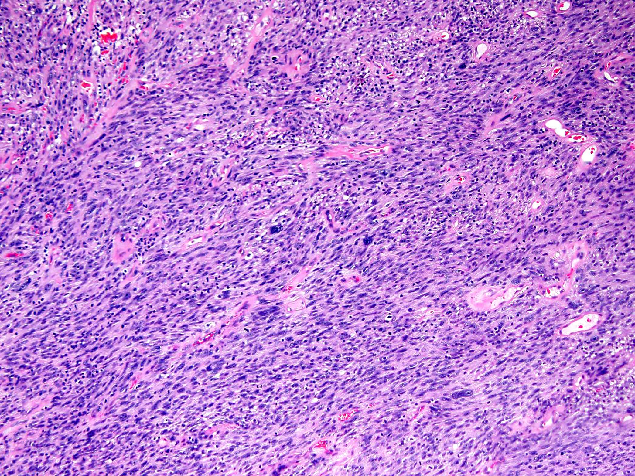 Pathology Outlines - Undifferentiated / unclassified sarcoma