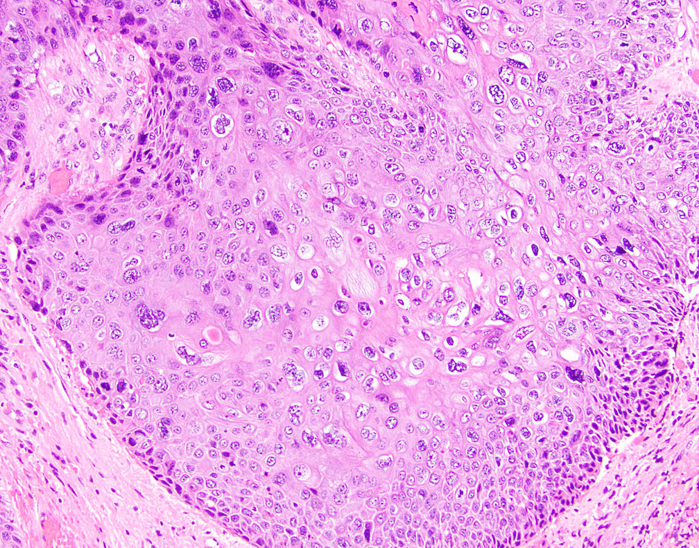 Superficial Squamous Cell Carcinoma