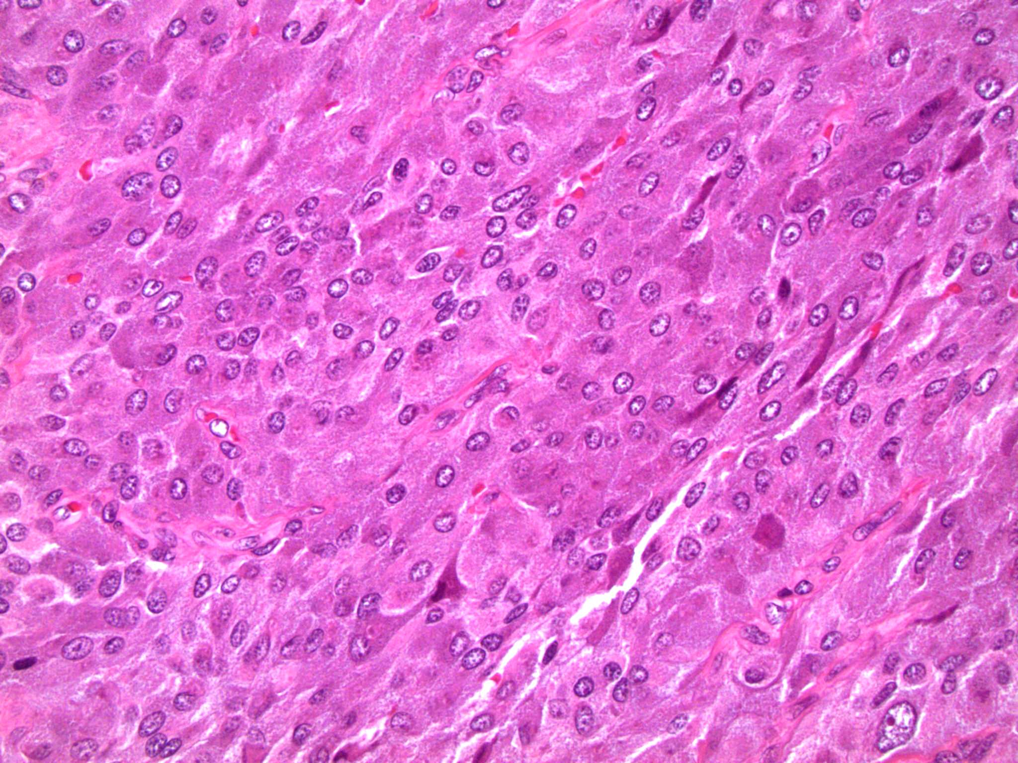 Pathology Outlines - Paraganglioma