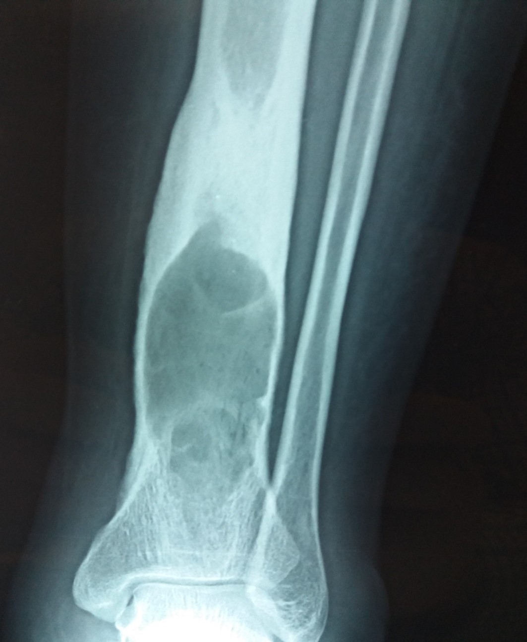 Pathology Outlines Chronic Osteomyelitis