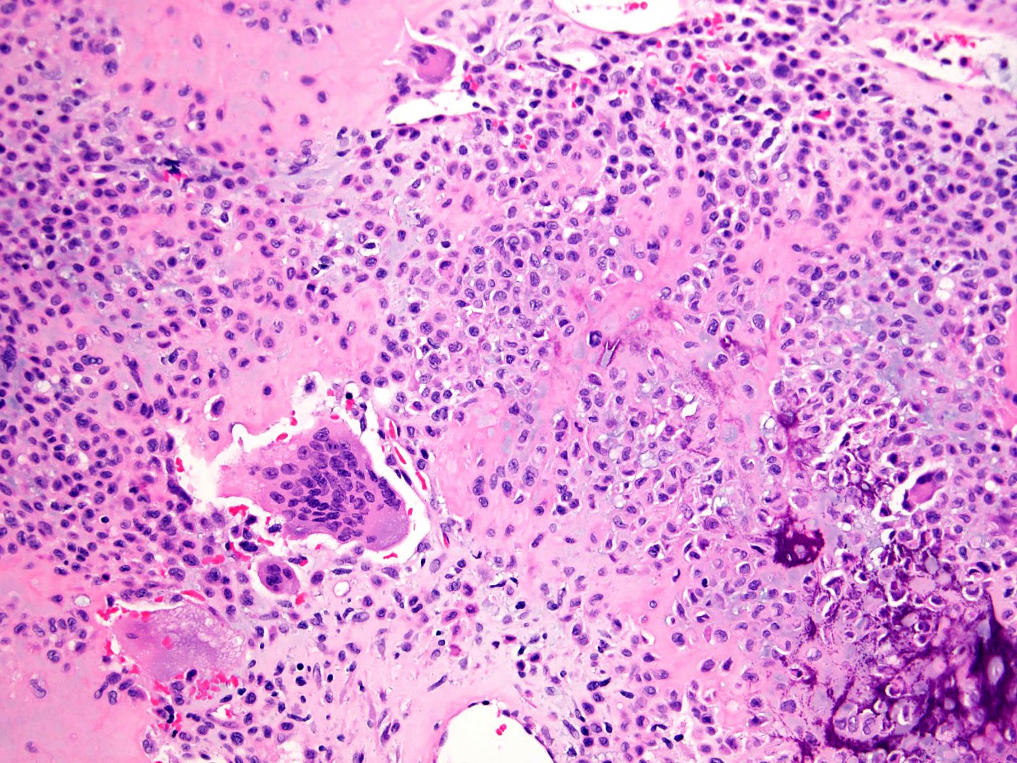Pathology Outlines Giant Cell Tumor Of Bone Nos