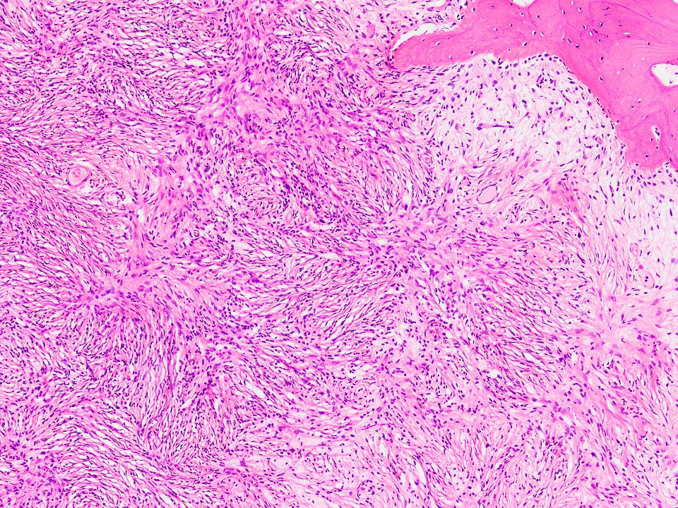 Pathology Outlines Nonossifying Fibroma