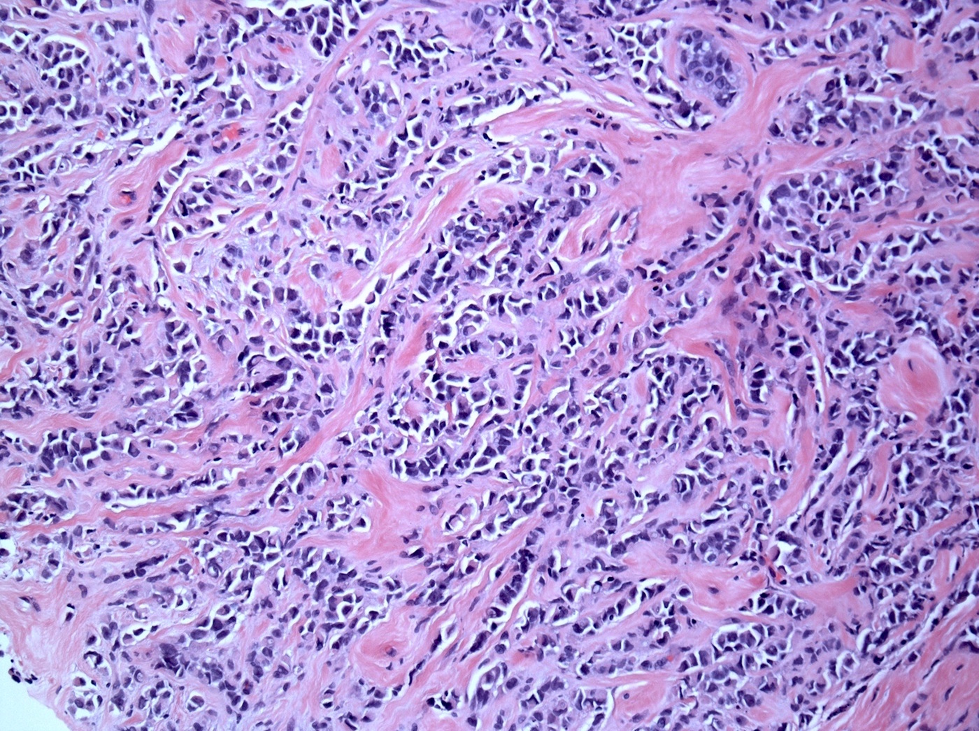 Pathology Outlines Pleomorphic Lobular Carcinoma 