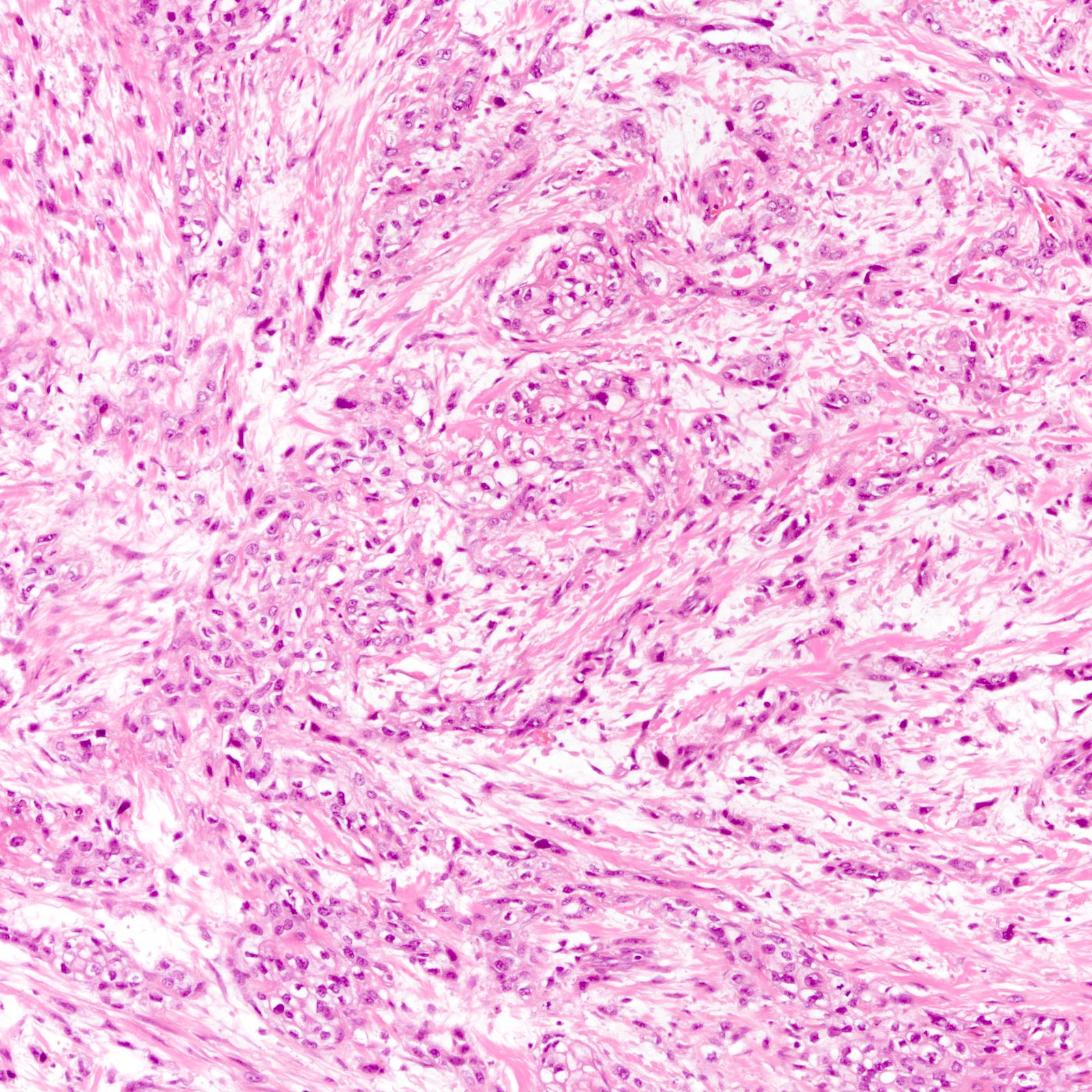 pathology-outlines-triple-negative-breast-cancer