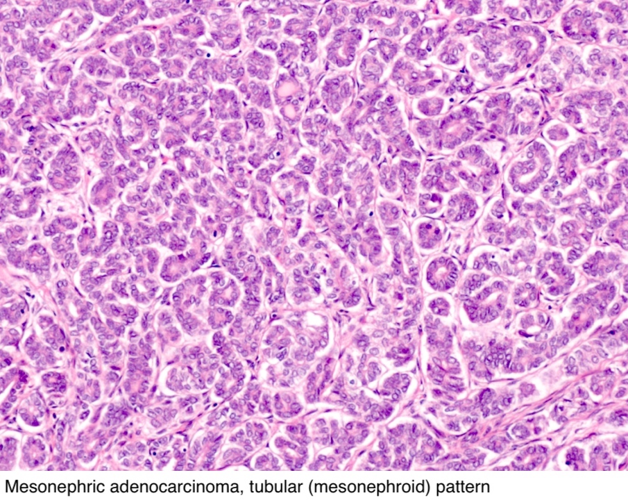 Pathology Outlines - Mesonephric adenocarcinoma