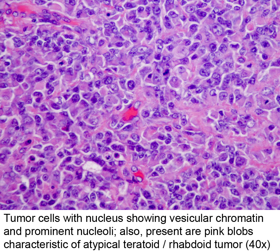 Pathology Outlines - Atypical Teratoid / Rhabdoid Tumor