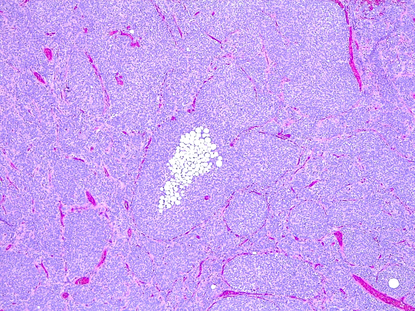 Pathology Outlines - Cerebellar liponeurocytoma