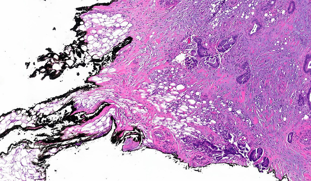 Pathology Outlines - Staging-carcinoma