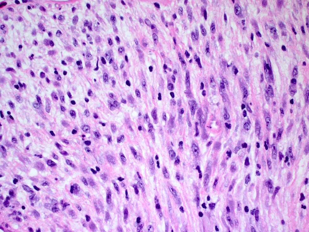 Pathology Outlines Inflammatory Myofibroblastic Tumor