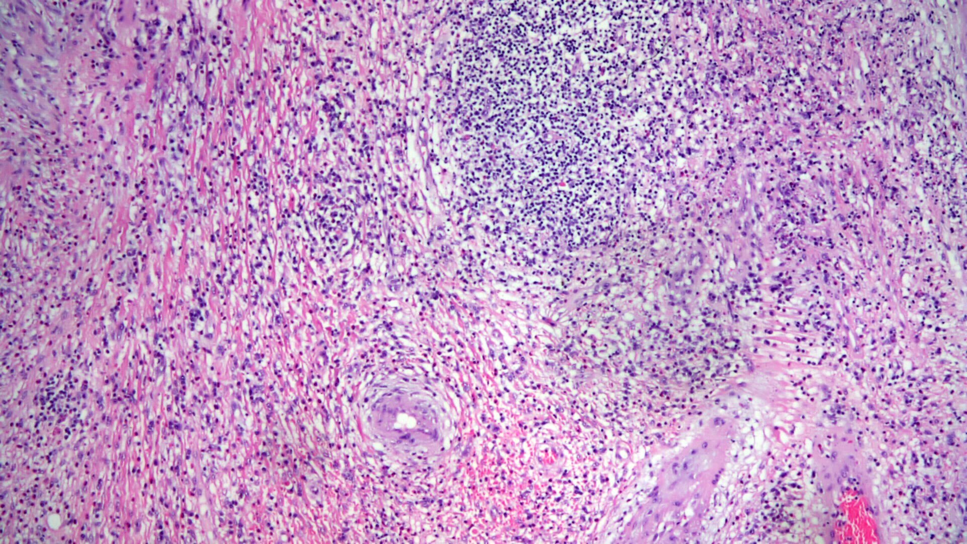 Pathology Outlines Inflammatory Fibroid Polyp