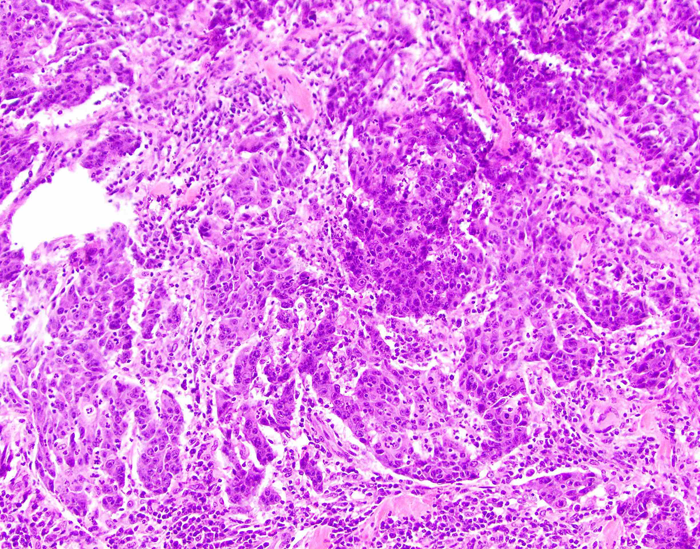 medullary carcinoma