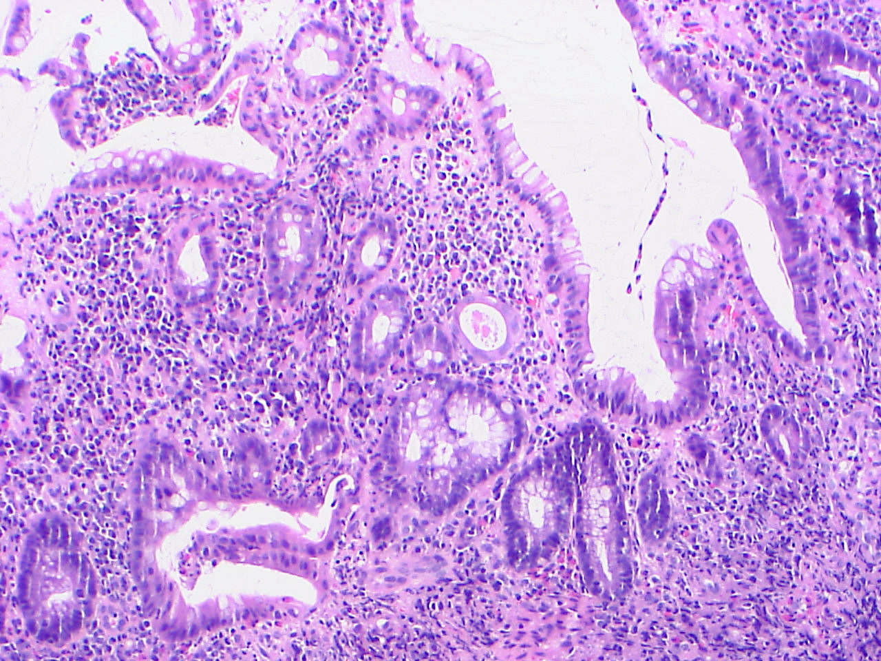 pathology-outlines-ulcerative-colitis