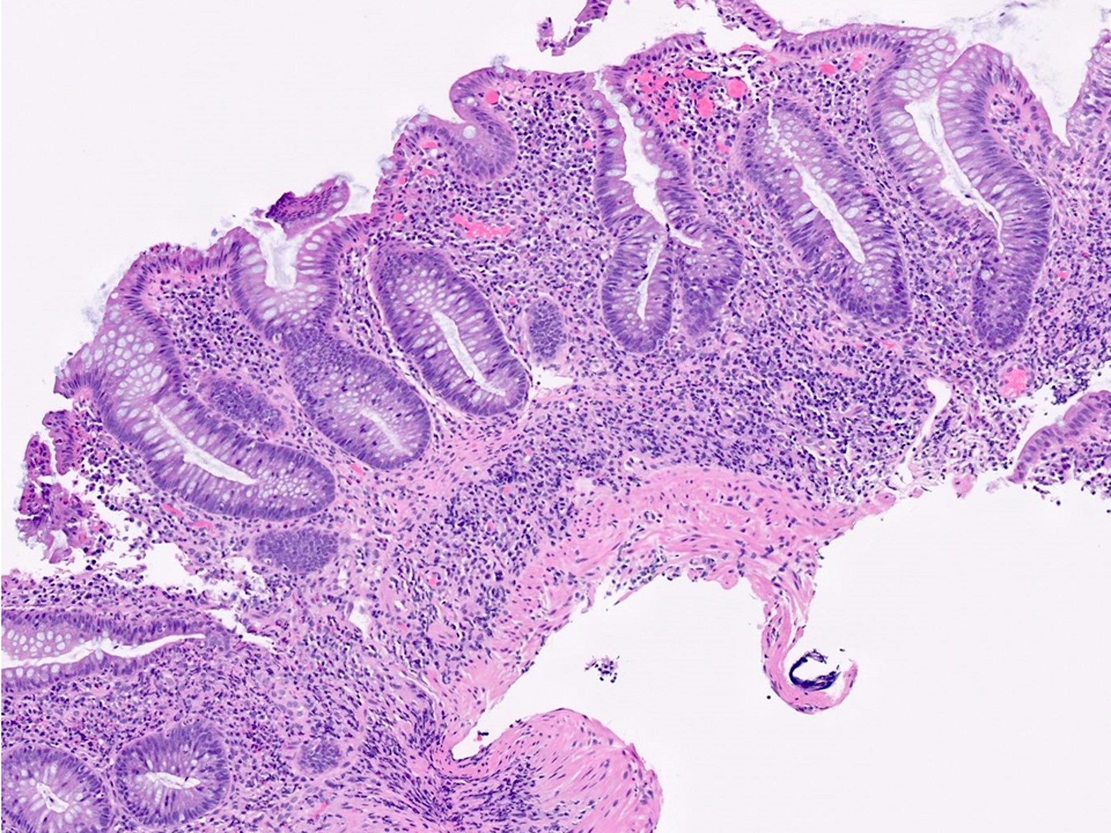 Proctosigmoiditis?, Ulcerative Colitis