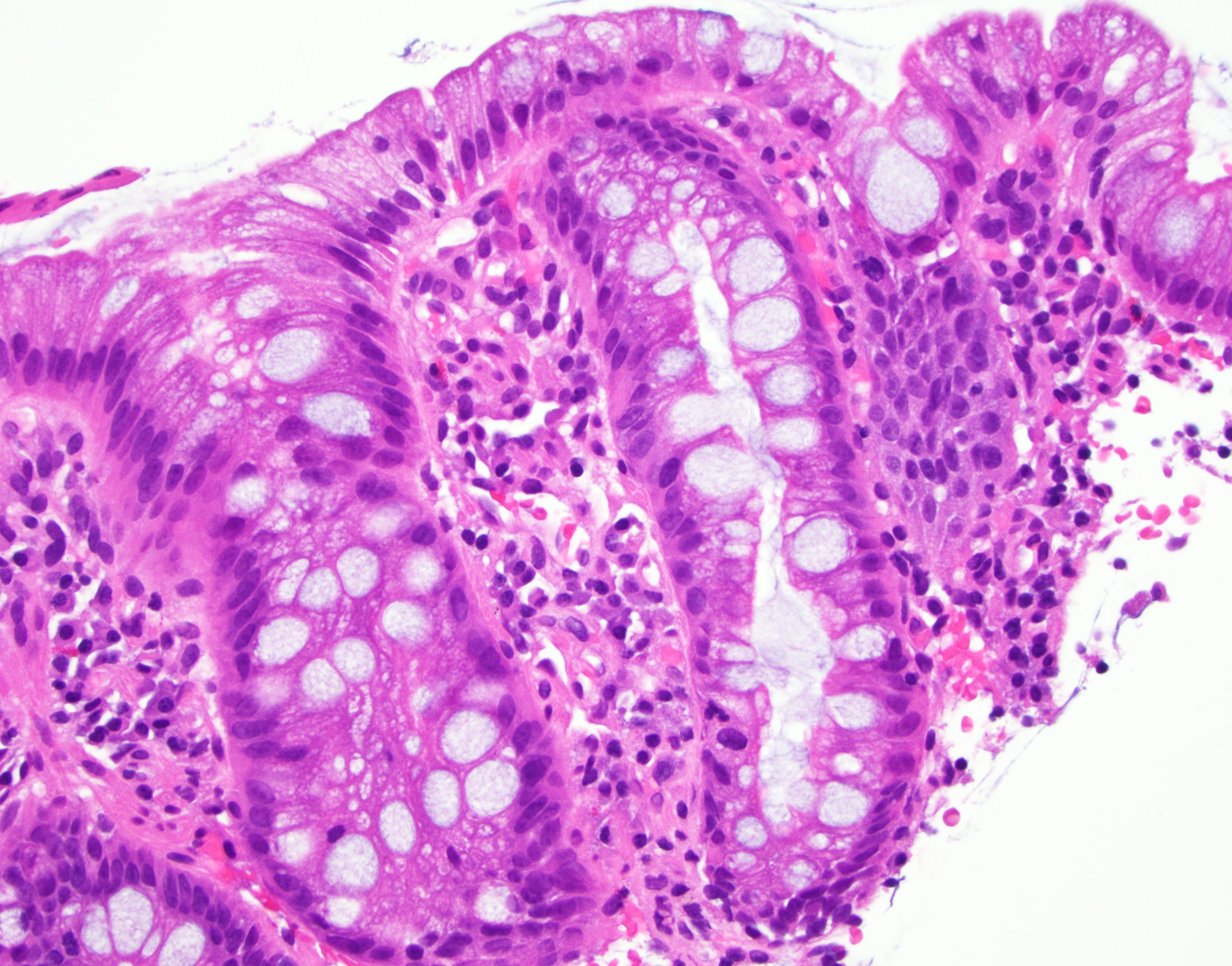 barretts esophagus histology