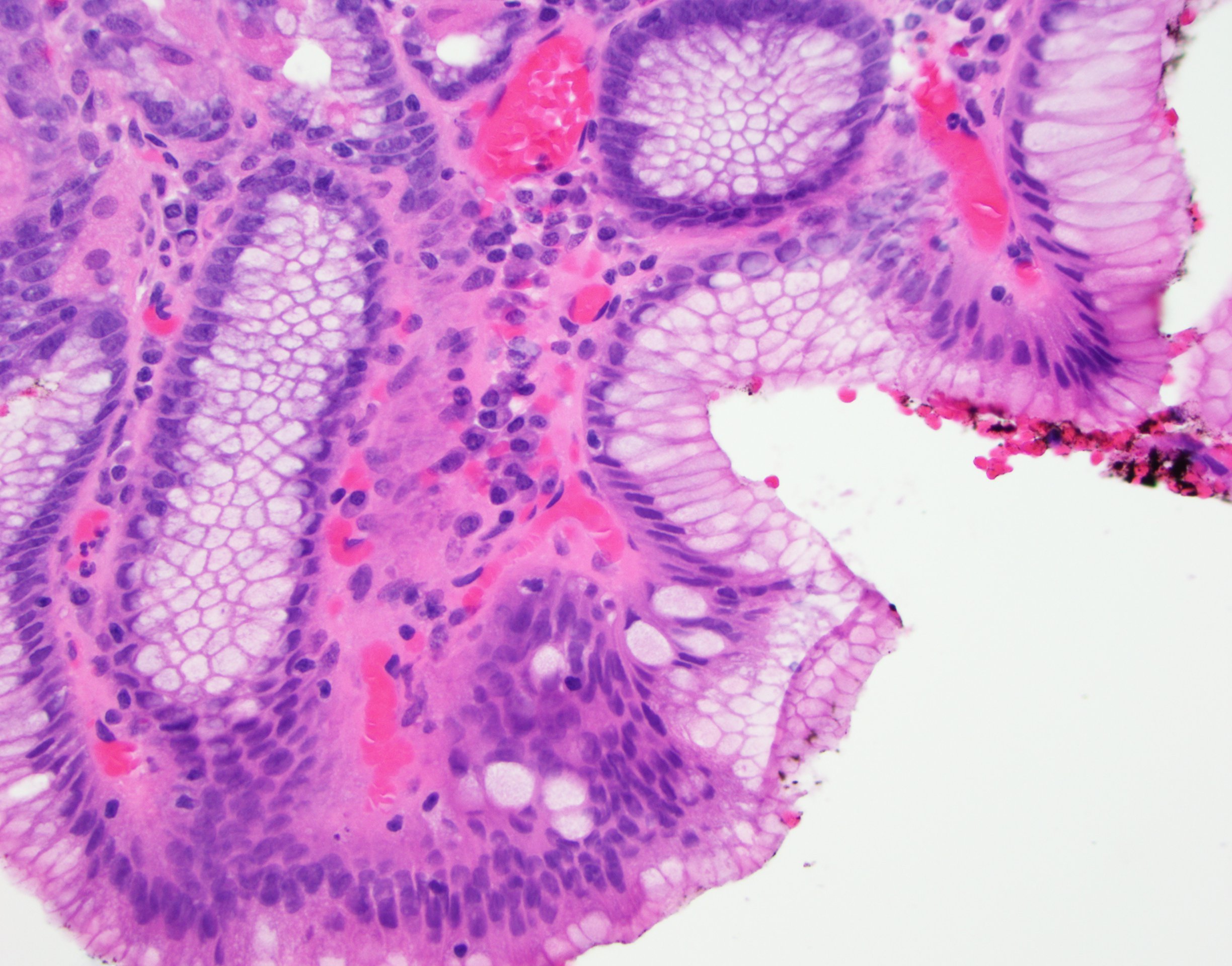 barretts esophagus histology