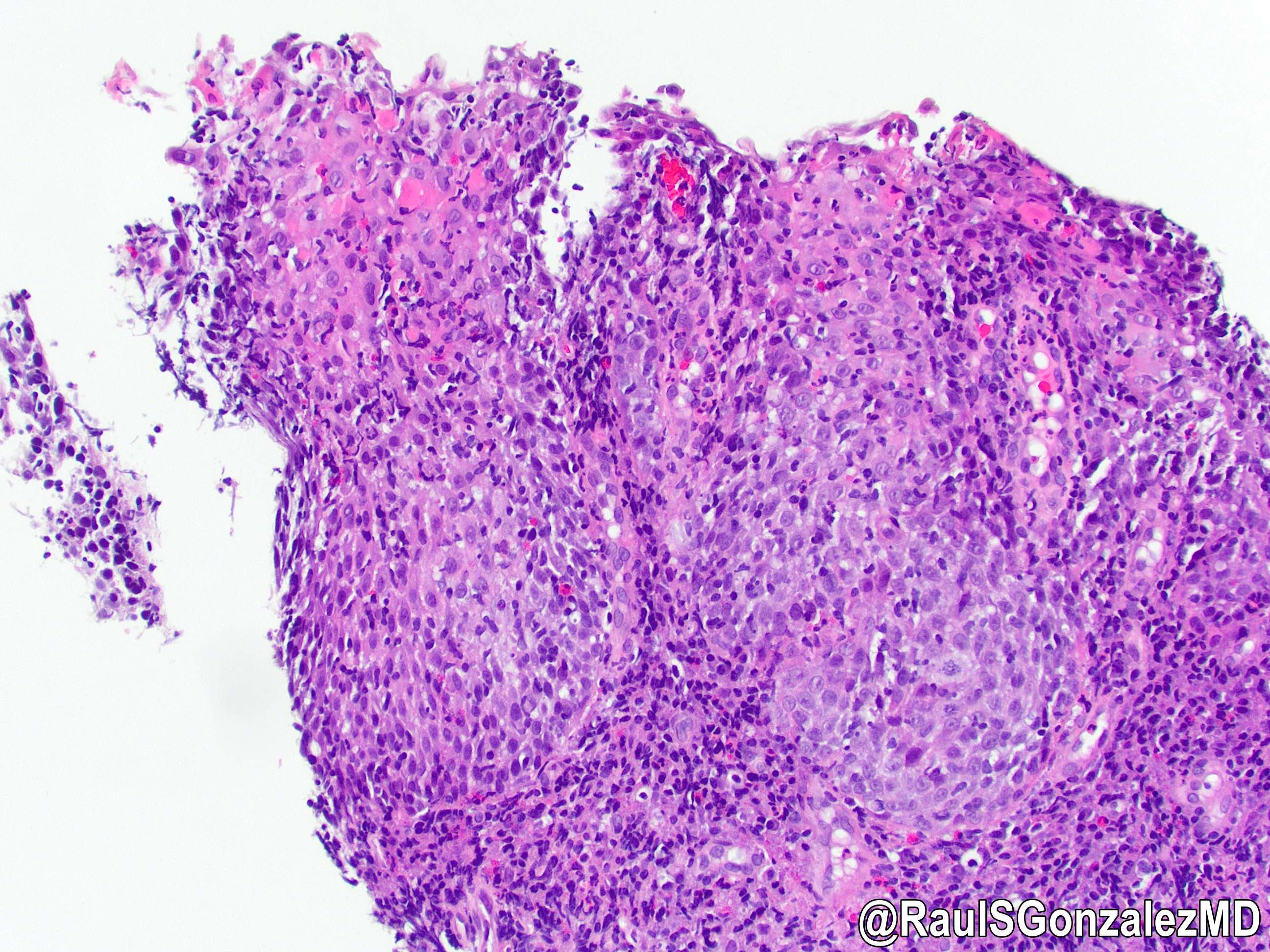 Pathology Outlines - Lymphocytic esophagitis