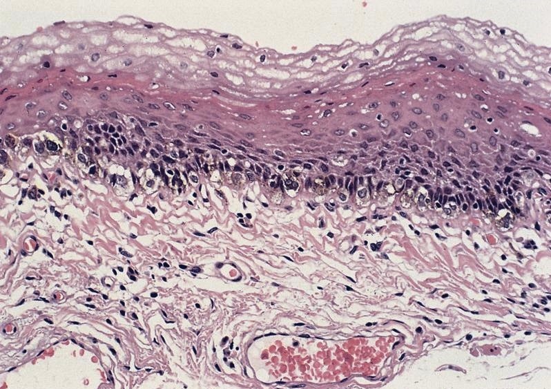 Pathology Outlines - Melanoma