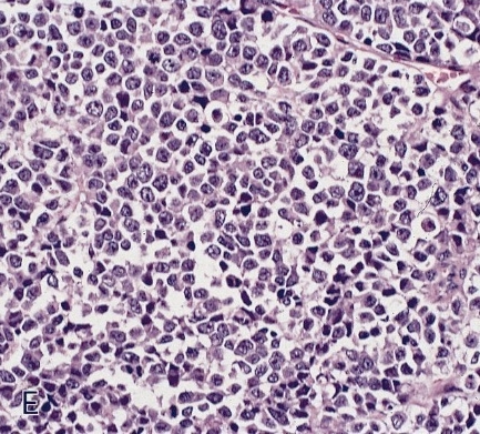 Pathology Outlines - Neuroendocrine carcinoma