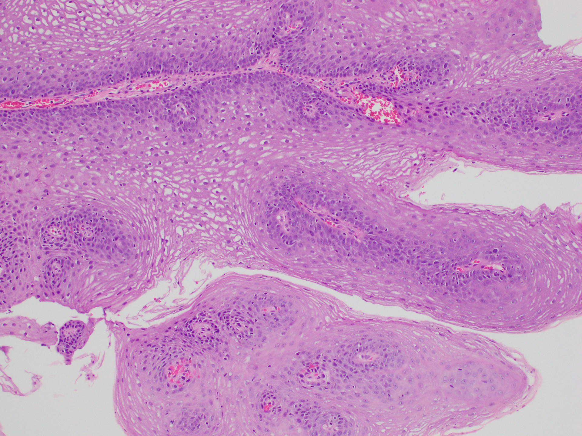 Esophageal Squamous Papilloma Histology Squamous Papilloma Of Esophagus
