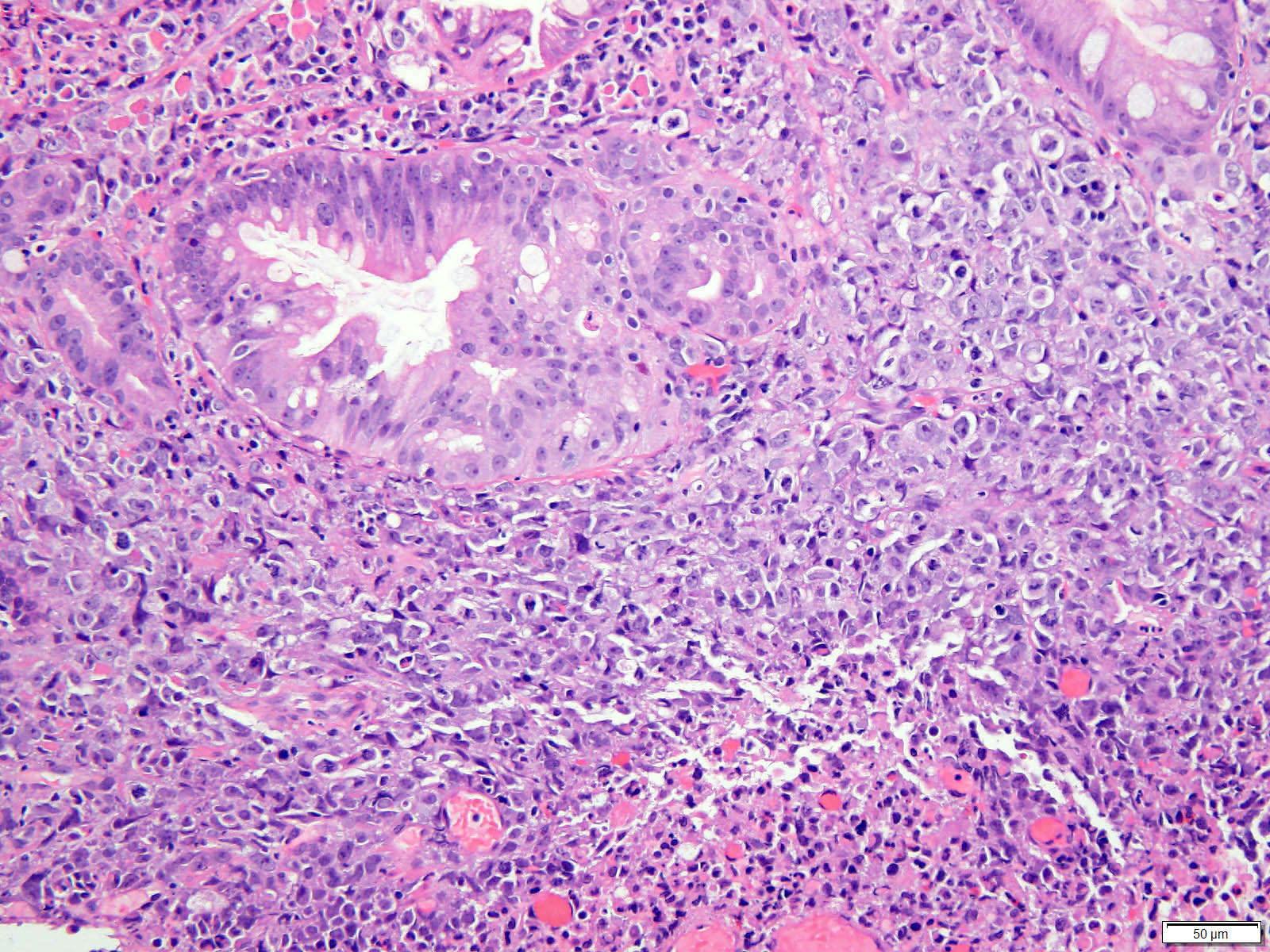 Esophageal Squamous Cell Carcinoma Histology