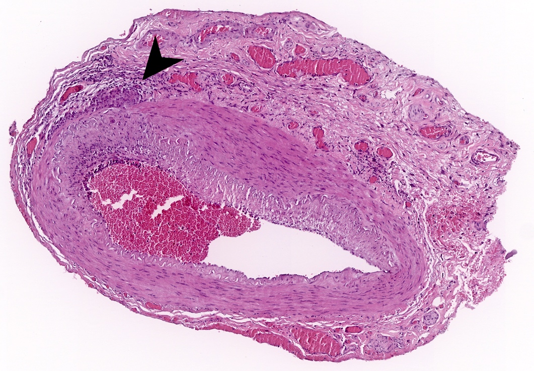 https://www.pathologyoutlines.com/imgau/eyeorbittemporalarteritisPenaZoroquiain01.jpg