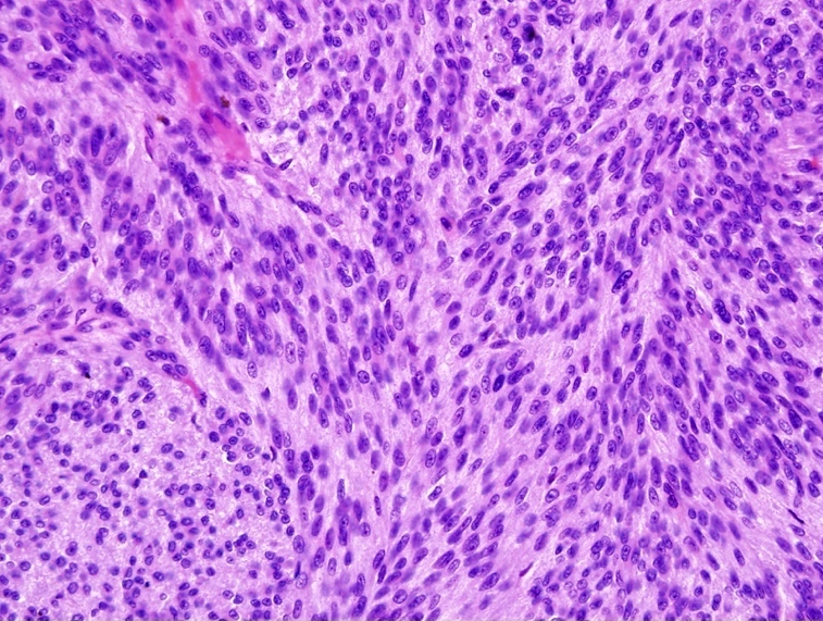 choroidal melanoma pathology