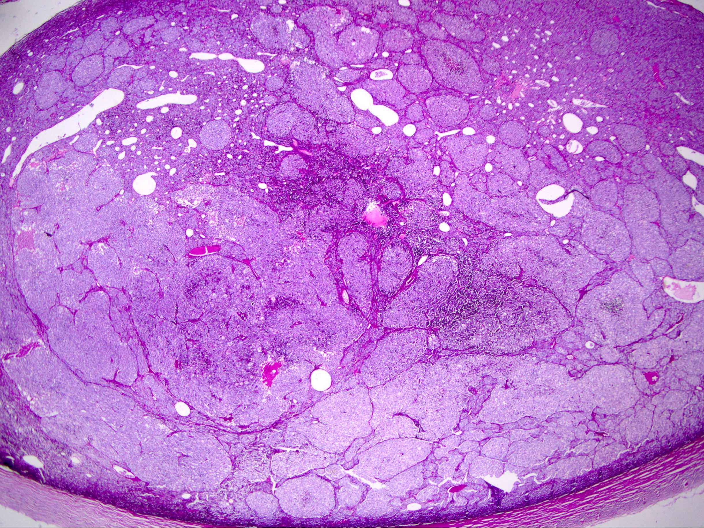 choroidal melanoma pathology