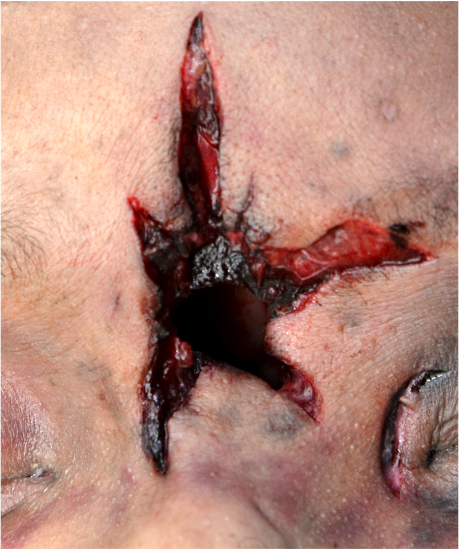 bullet wound treatment