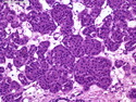 Pathology Outlines - Oncocytoma