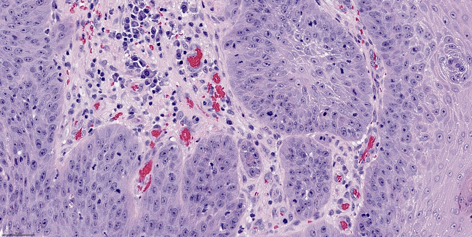 Pathology Outlines Papilloma