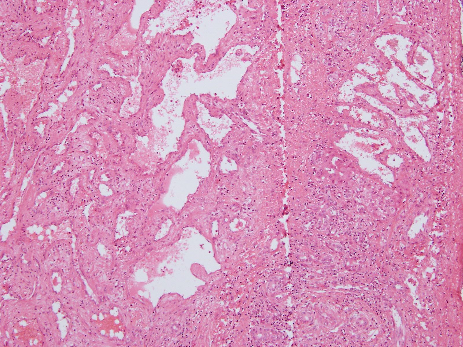 pathology-outlines-hemangioma