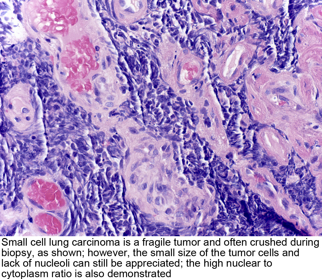 Pathology Outlines - Small cell carcinoma