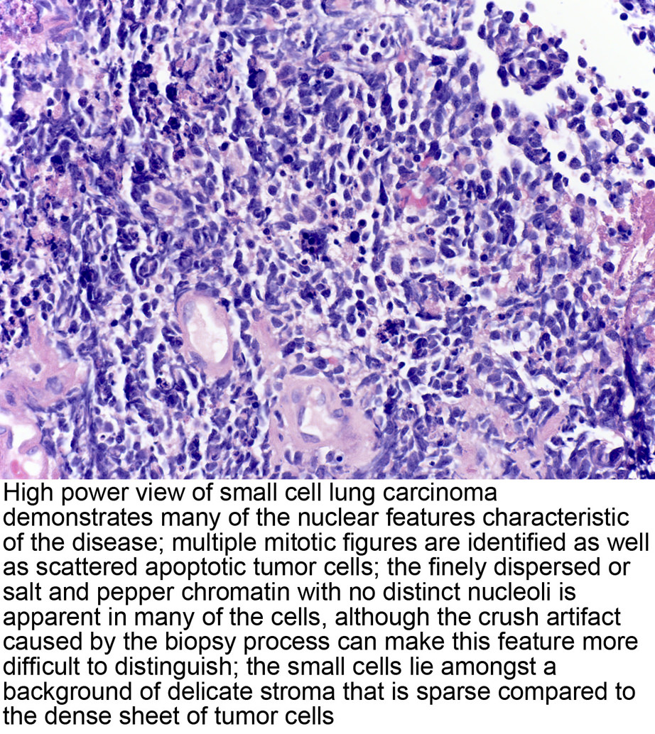 Lung Cancer Histology Types | My XXX Hot Girl
