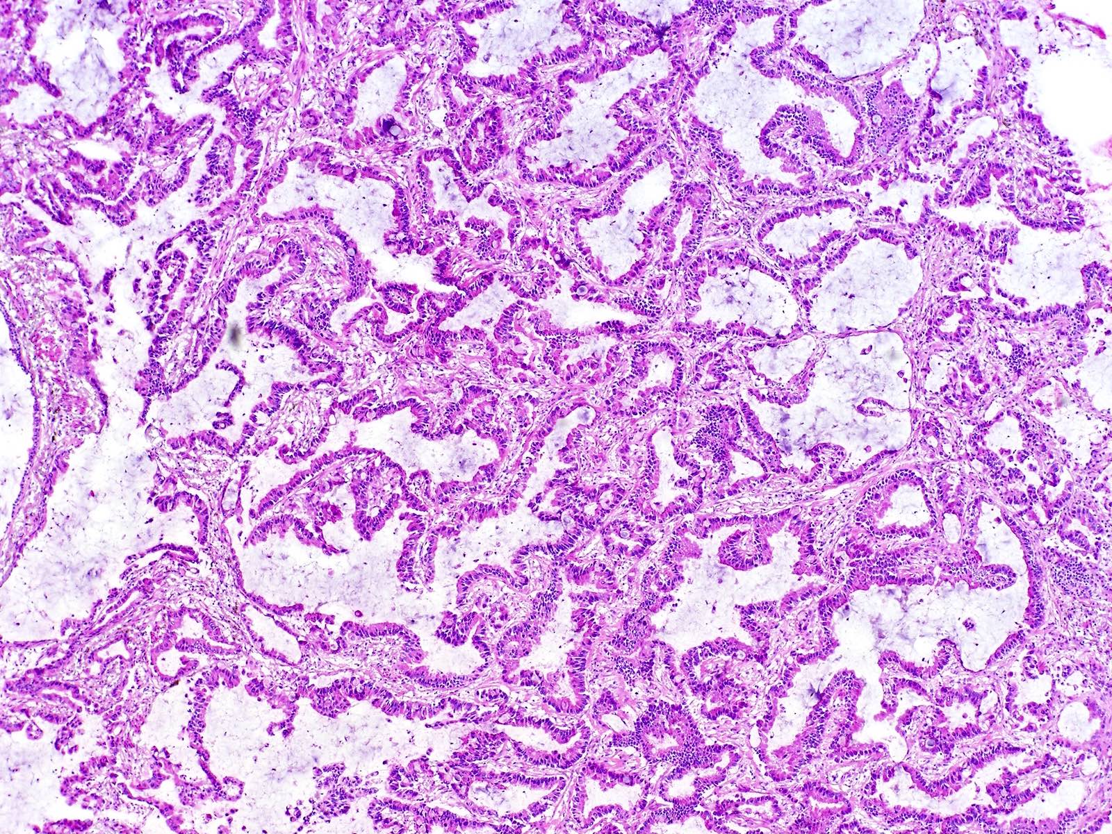 Lung Carcinoma Histology