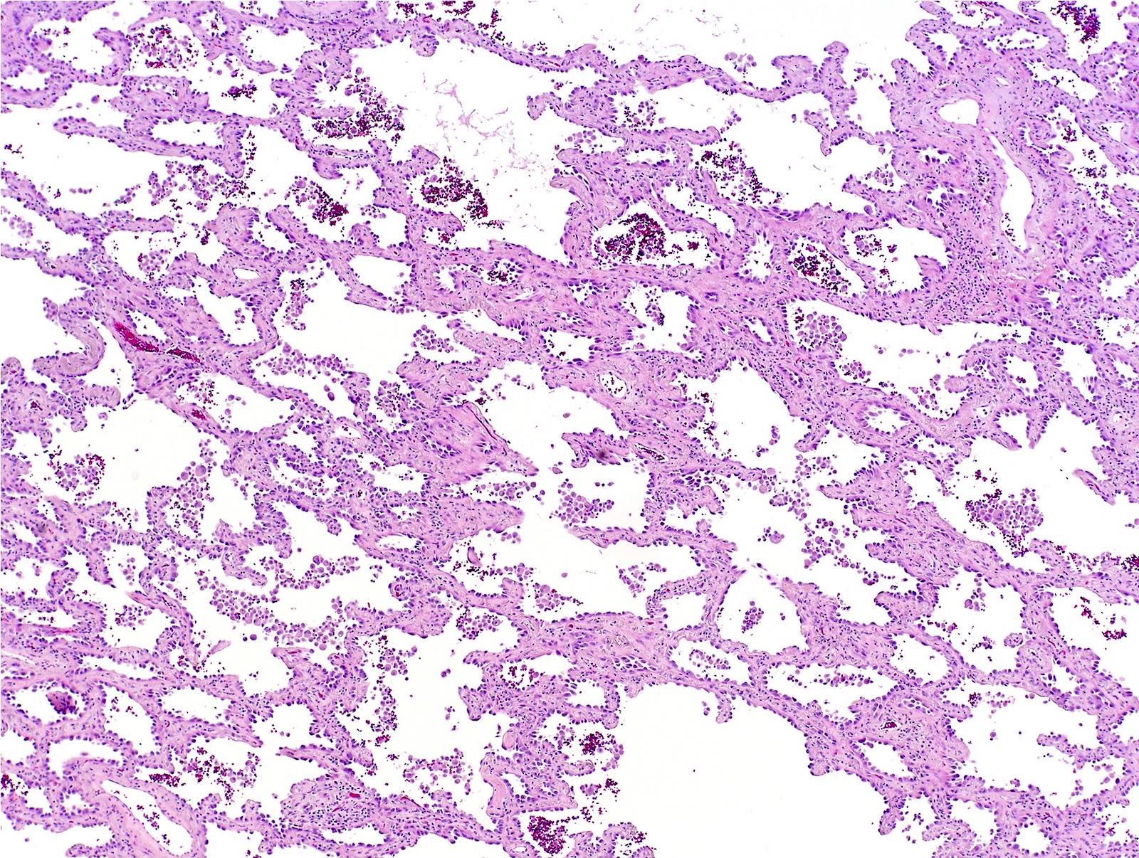 Pathology Outlines - Adenocarcinoma overview