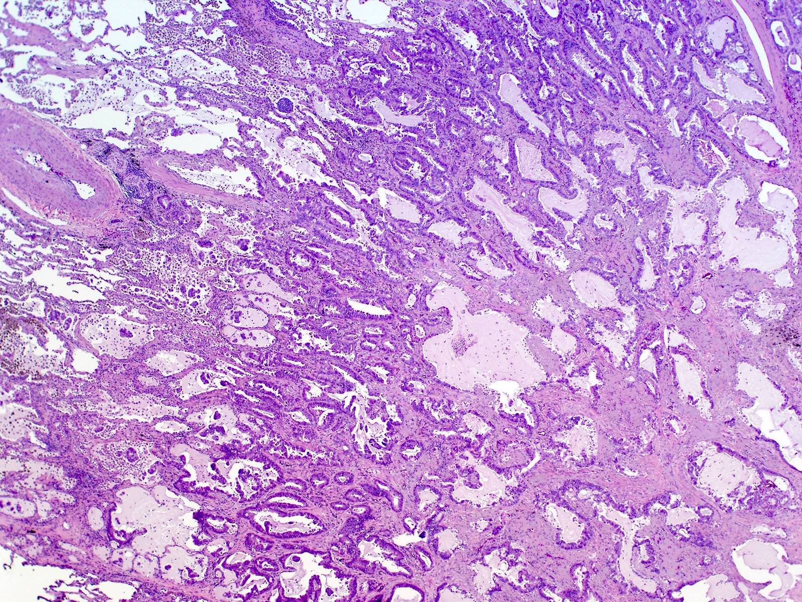 small cell lung cancer histology