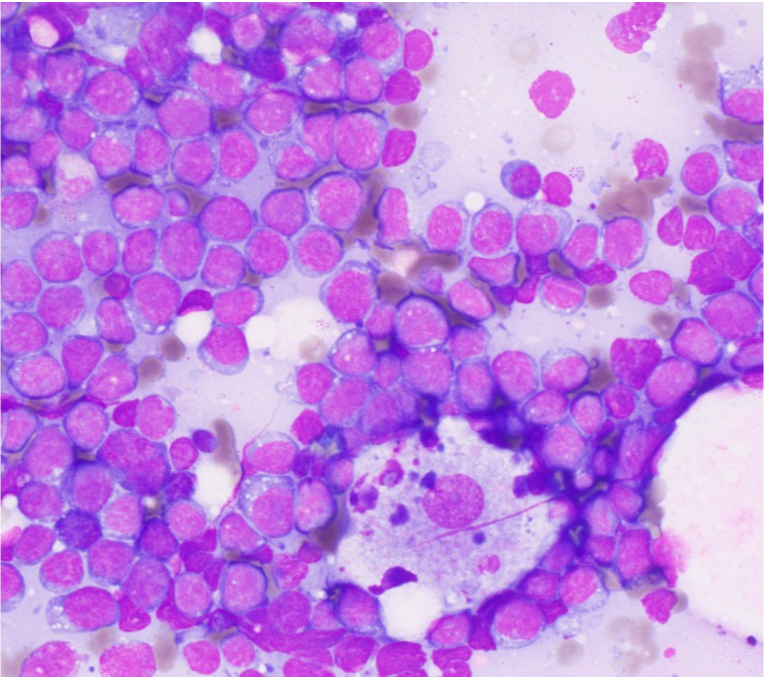 Pathology Outlines - Burkitt Lymphoma