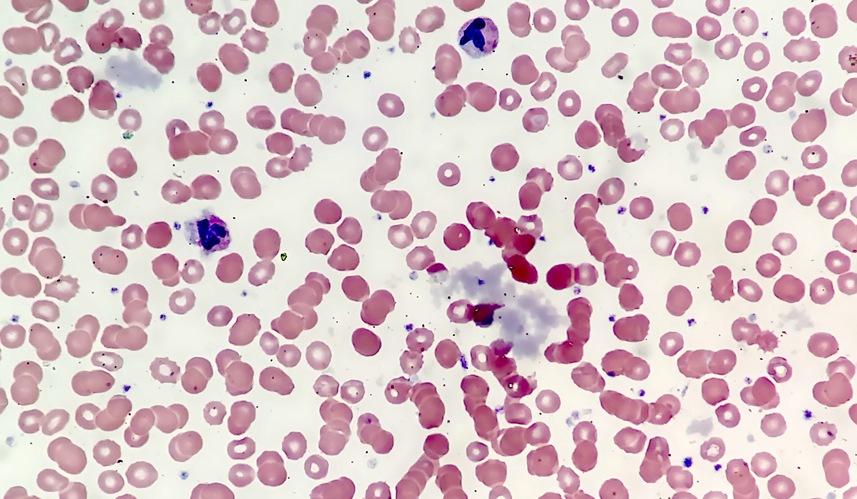 Pathology Outlines Cryoglobulinemia