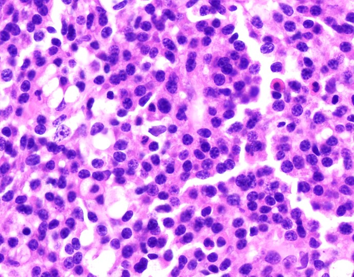 Pathology Outlines - Plasma cell leukemia